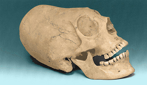 Torzított hun koponya